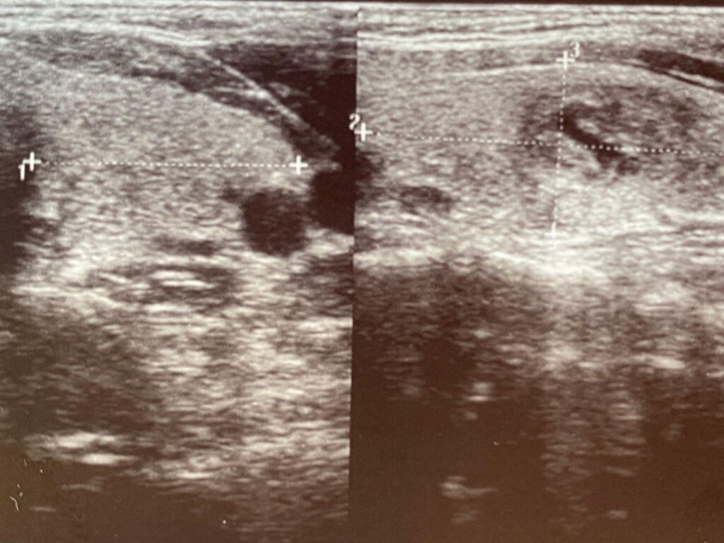 유두암과 여포암
